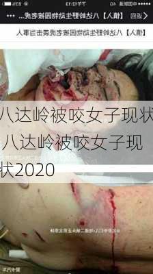 八达岭被咬女子现状,八达岭被咬女子现状2020